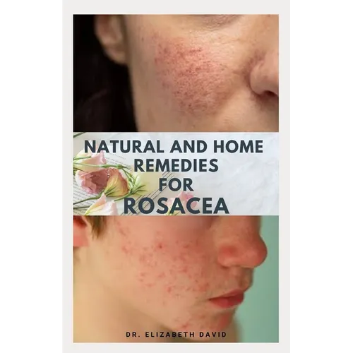 Natural and Home Remedies for Rosacea: A Self Help Guide To Completely Prevent and Treat Rosacea