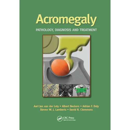 Acromegaly: Pathology, Diagnosis and Treatment