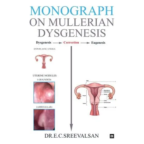 Monograph on Mullerian Dysgenesis