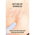 Get Rid Of Shingles: Stop Fast Burning And Itching Associated: Shingles On Face Treatment