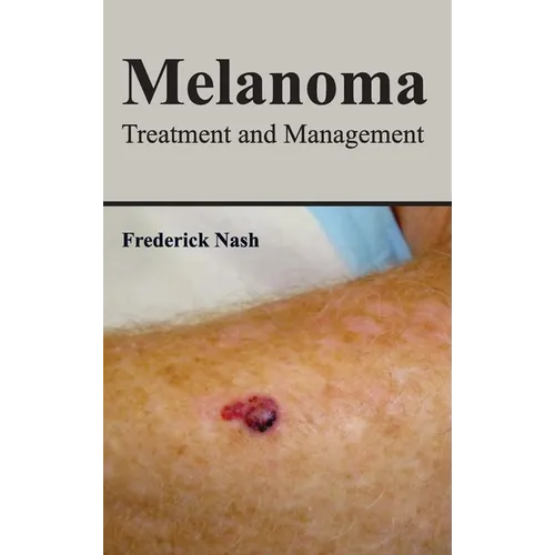 Melanoma: Treatment and Management