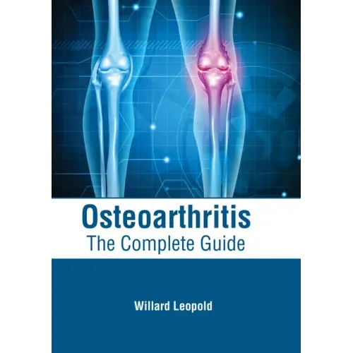 Osteoarthritis: The Complete Guide