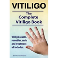 Vitiligo. Vitiligo causes, remedies, costs and treatment all included. The complete Vitiligo Book.