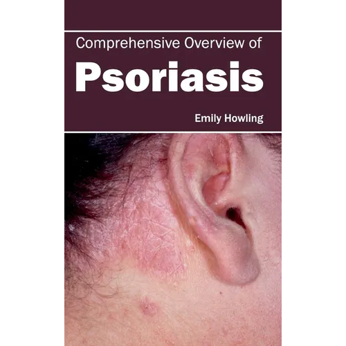 Comprehensive Overview of Psoriasis - Hardcover
