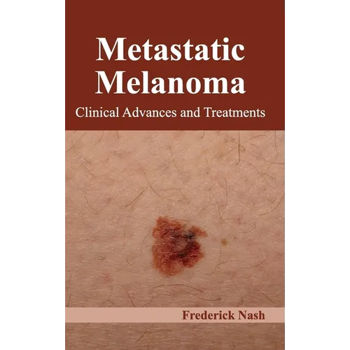Metastatic Melanoma: Clinical Advances and Treatments