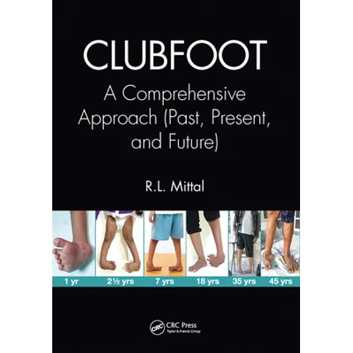 Clubfoot: A Comprehensive Approach (Past, Present, and Future)