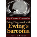 My Cancer Chronicles: Being Diagnosed with Ewing's Sarcoma
